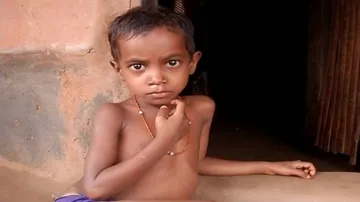 Nagada Run Continues In Odisha: Severely Acute Malnourished Under-5 Children Up At 2.57 L