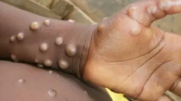 Monkeypox spreads to more European countries, Australia, Canada
