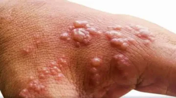 Why monkeypox can end up as large-scale global outbreak