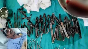 63 spoons removed from man's stomach after 2-hr-long operation