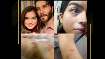 Pakistani star Feroze Khan’s ex-wife shares shocking pics of domestic violence