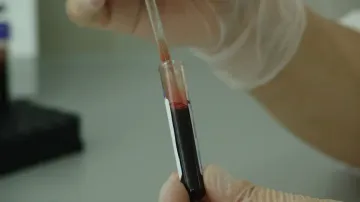 stem cell therapy