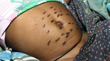 Infant branded with hot iron, hospitalized