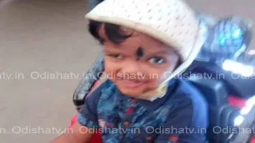 Separation of Conjoined Twins: One year on, Jaga’s improvement beyond expectation