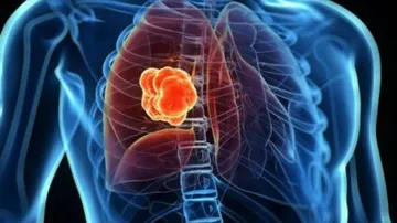 AstraZeneca Partners With Qure.ai To Bring AI Solutions To Detect Lung Cancer