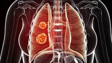 AI To Determine If Immunotherapy Is Working In Lung Cancer
