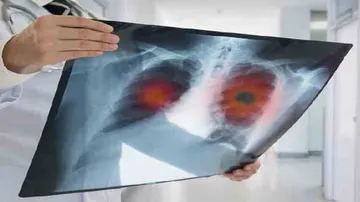 New technology may detect early-stage lung cancer