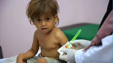 Centre To Launch Nutrition Drive For Severely Acute Malnourished Children