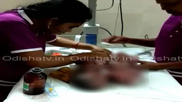 Nayagarh conjoined twins share one heart, liver