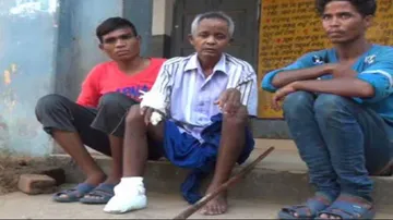 Odisha Migrant Labourer's Fingers, Toes Chopped Off By Agent In Maharashtra