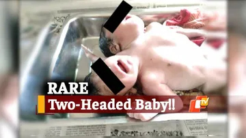 Baby Girl With 2 Heads Born In Odisha’s Kendrapara, Shifted To Cuttack Shishu Bhawan