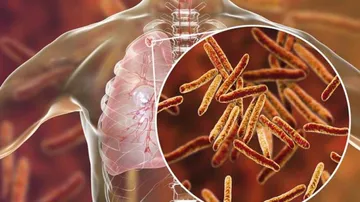 21.5 lakh TB cases reported in India in 2018: Report
