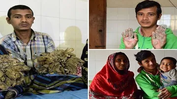 Bangladesh 'tree man' trapped in hospital for two years
