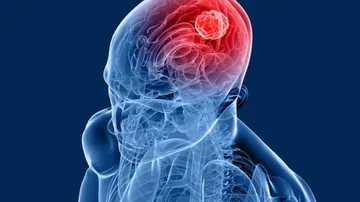 Brain tumour no longer scary, say doctors