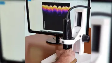 'Virtual biopsy' device to help detect skin tumours