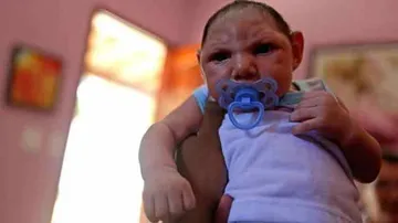 Malnutrition Linked To Increased Risk Of Zika Birth Defects