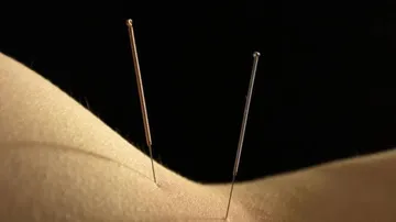 Acupuncture may boost chances of pregnancy through IVF