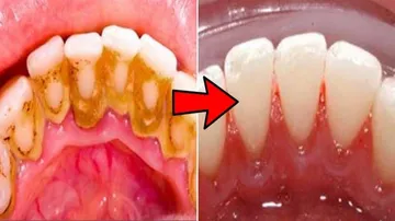 Oral Hygiene At Risk! Things You Must Know To Avoid Dental Problems