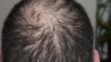 baldness