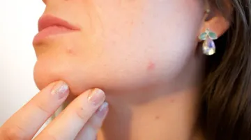blackheads