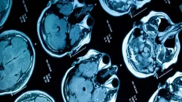 Brain scans help predict learning problems: study