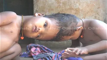 Odisha govt gives Rs 1 cr for surgery of Kandhamal conjoined twins