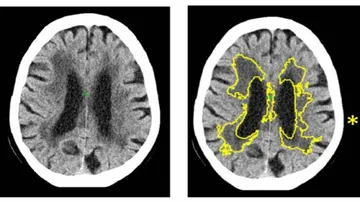 AI-based software may help predict risk of dementia