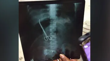 Doctors at Hyderabad's NIMS leave forceps in patient's abdomen