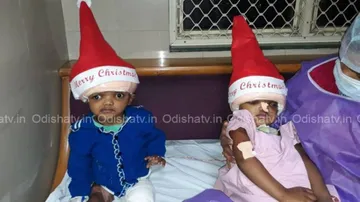 Separated conjoined twins to take 8-9 months to get discharged, says AIIMS