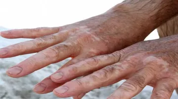DRDO scientist develops herbal drug to treat leucoderma