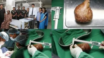 SL Army doctors set Guinness Record after removing world's largest & heaviest kidney stone