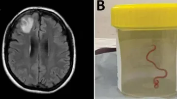 8-cm live worm removed from woman's brain in world's 1st discovery