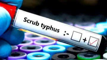 Scrub Typhus