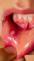 5 Effective Home Remedies For Mouth Ulcers
