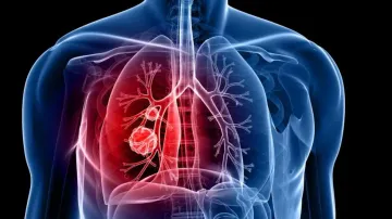 Lung cancer