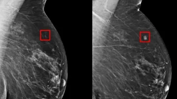 How Mirai AI model detects early breast cancer; know here