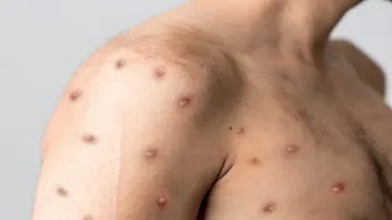 First MPox case confirmed in Kerala 