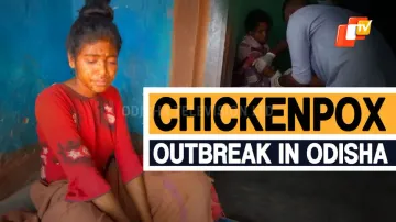 3 Critical, 30 Affected Due To Chickenpox Outbreak In Odisha’s Gajapati District 