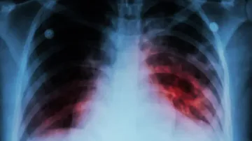 21.69 lakh TB cases notified between Jan-Oct: Centre