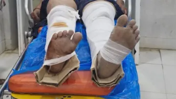 Cardboard to treat fracture! Odisha hospital under scanner