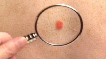 Researchers identify novel protein linked to skin cancer