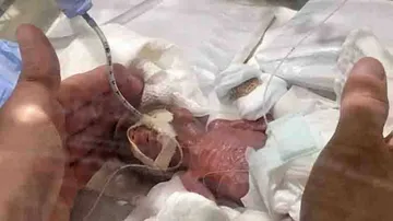 World's smallest baby boy weighing 268 grams sent home healthy