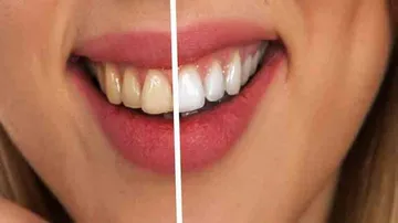 Whitening products may cause tooth decay, claim researchers