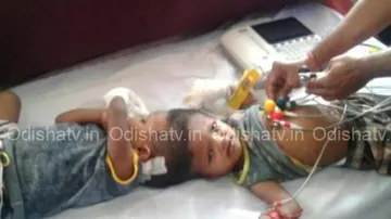 Conjoined twins Jaga Kalia stable after first phase surgery at AIIMS