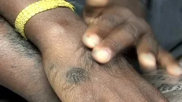 Odisha boy with rare disorder awaits miracle treatment