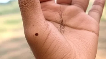 Hair Moles Treatment