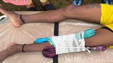 Tarak Hembram Injury: জোড়া ছাতা দিয়ে বাংলার ফুটবলার তারক হেমব্রমের চোটগ্রস্ত পায়ে সাপোর্ট
