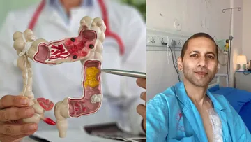 Colon Cancer- विभु राघव