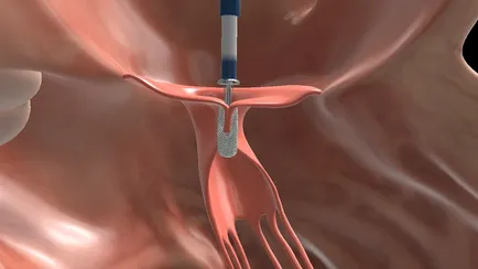 A close-up of a medical device

AI-generated content may be incorrect.