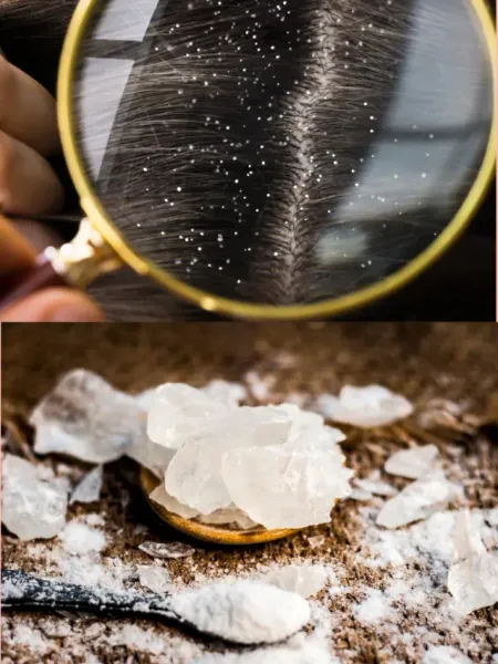 Fitkari se 5 minute mein kese dur karein Dandruff